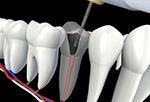 Eric T. Yokota, endodontic-retreatment